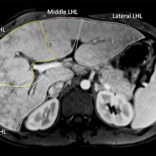 A 12-year-old boy with Fontan palliation due to hypoplastic left heart... | Download Scientific ...