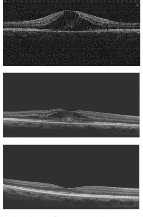 Figure 2 from Cystoid macular edema after cataract surgery in a patient with previous severe ...