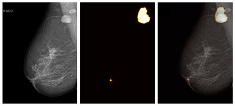 Diagnostics | Free Full-Text | Detecting Abnormal Axillary Lymph Nodes on Mammograms Using a ...