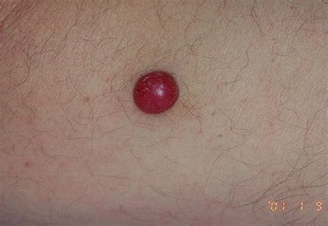 Red Nodular Melanoma