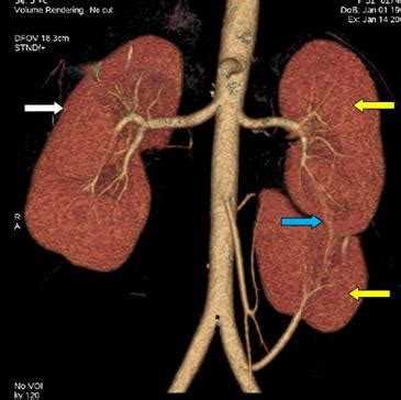 35-year-old female with right iliac fossa pain. Triphasic CT with 60ml... | Download Scientific ...