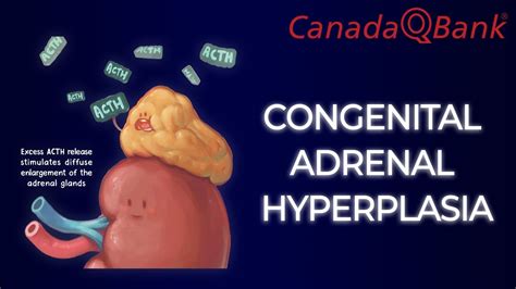 Congenital Adrenal Hyperplasia And Testicular Feminization Syndromes Dr