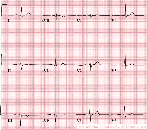 QRS axis and voltage - wikidoc