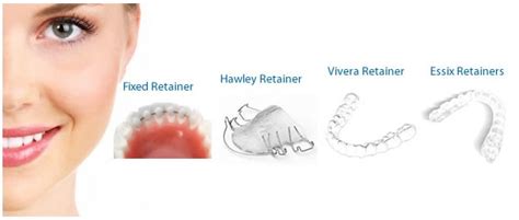 Retainer for Braces | Cost of Retainers | Clear, Hawley, Vivera