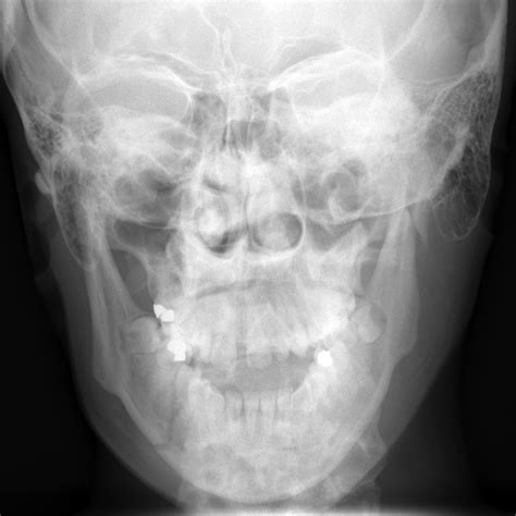 Orif Mandibular Fracture