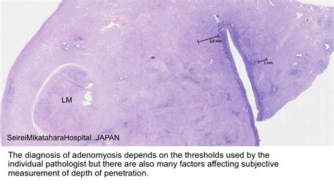 Pathology Outlines - Adenomyosis