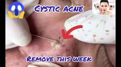 Cystic Acne extraction this week , Blackheads remove pimple popping #23 - YouTube