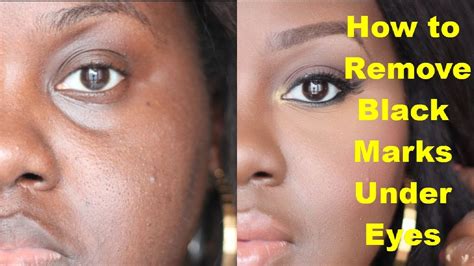 How to Remove Black Marks Under Eyes? Get Rid of Dark Circles - YouTube