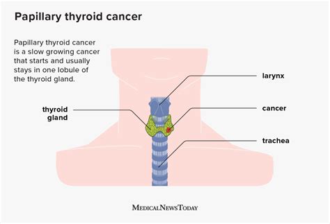 Papillary thyroid cancer (PTC): Symptoms and more