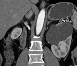 Renal Cysts With Septations - Kidney Case Studies - CTisus CT Scanning