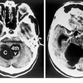 (PDF) Unusual arachnoid cyst of the quadrigeminal cistern in a adult presenting with apneic ...