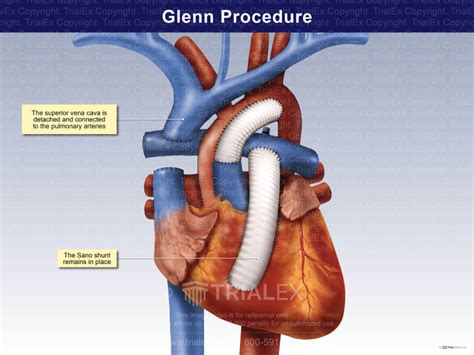 Glenn Procedure - Trial Exhibits Inc.