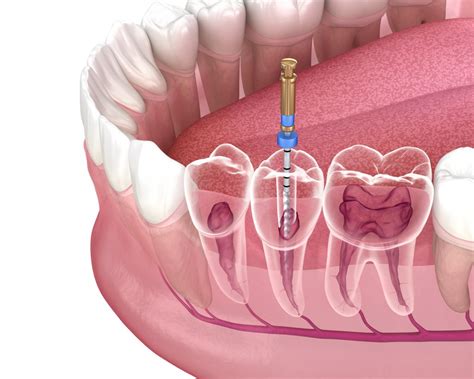 What is a Root Canal | Penn Dental Family Practice