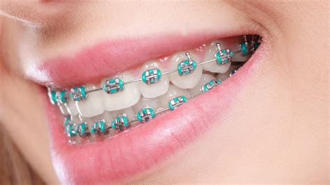 Metal braces – Im Orthodontics