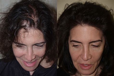 Hair Transplants for Women photos | Miami, FL | Patient58205