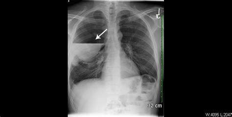 Bullous Lung Disease - The Western Journal of Emergency Medicine