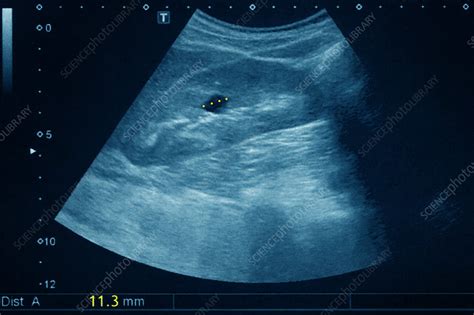 Kidney cyst, ultrasound - Stock Image - C026/8795 - Science Photo Library