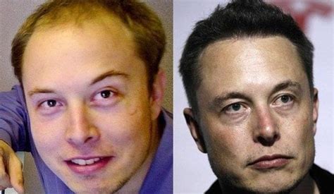 The Incredible Change of Elon Musk’s Hair (Before and After Photos)