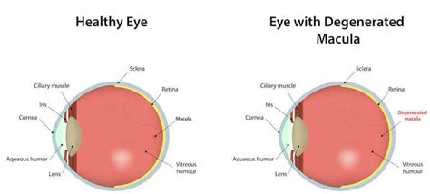 Macular Degeneration Las Vegas | Nevada Eye Physicians Henderson