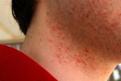 Pseudofolliculitis Barbae - Pictures, Treatment, Symptoms