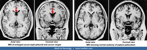 Cavum septi pellucidi and cavum vergae | MedLink Neurology