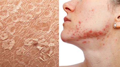 Dermatologists Reveal 5 Signs of Stressed Skin (And How to Heal It ...