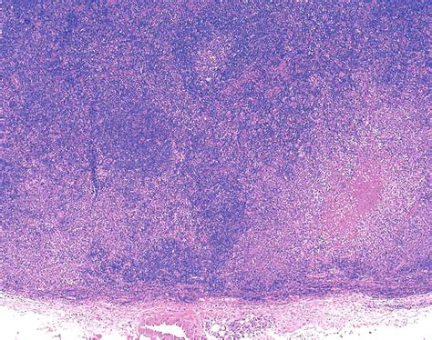 Pathology Outlines - Kikuchi disease