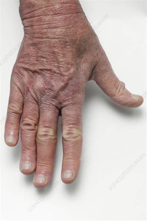 Muscles wasting in the hand - Stock Image - C016/6953 - Science Photo Library