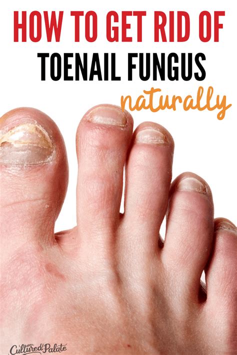 Natural Remedy for Toenail Fungus - Cultured Palate