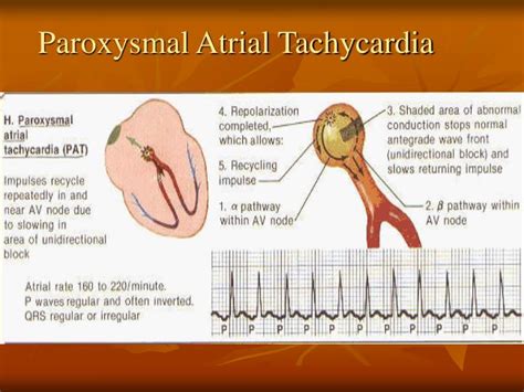 Paroxysmal Atrial Tachycardia