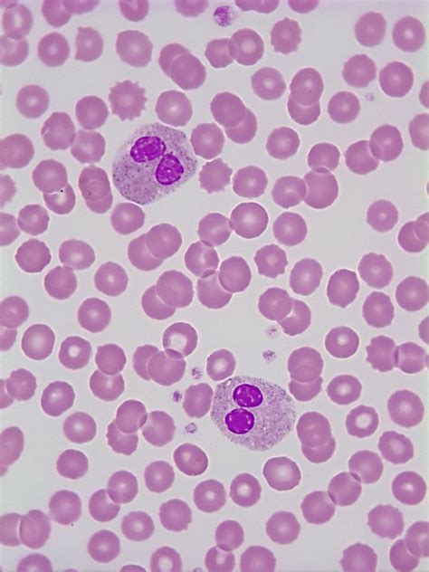 Hyposegmented Neutrophils