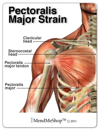 Pec Major Tendon Strain