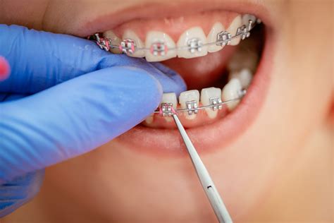 7 Questions to Ask Your Orthodontist Before Getting Braces