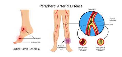 Peripheral Artery Disease | CTVS Texas