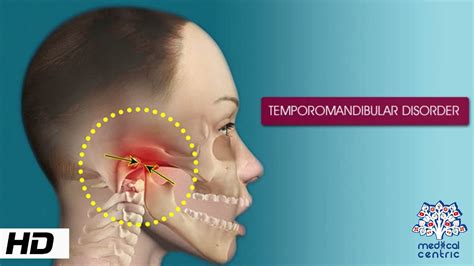 Temporomandibular Disorder, Causes, Signs and Symptoms, Diagnosis and ...