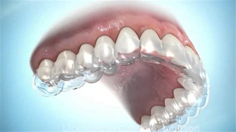 Clear Retainer - YouTube