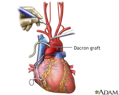 Dacron graft Information | Mount Sinai - New York