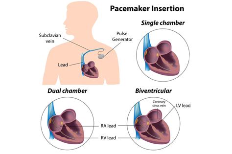 Pacemaker implantation - Why it's performed - NHS