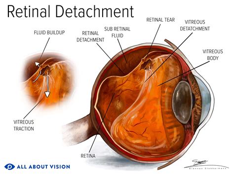 Retinal Detachment Vision