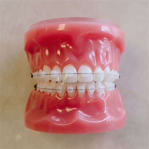 Ceramic Braces | Saddle Creek Orthodontics | Germantown Braces