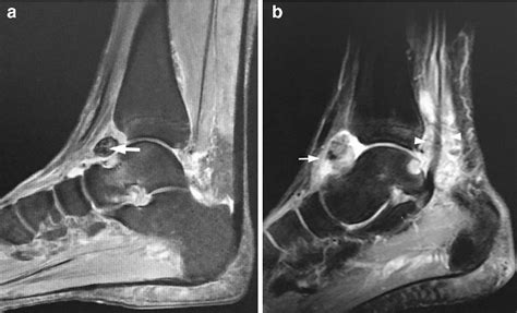 Pigmented Villonodular Synovitis