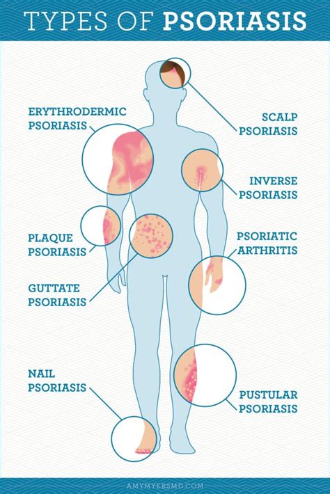 Natural Psoriasis Treatment from the Inside Out | Amy Myers MD