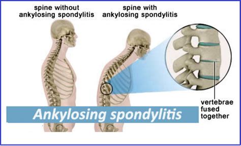 Ankylosing spondylitis cervical spine x ray - dolftc