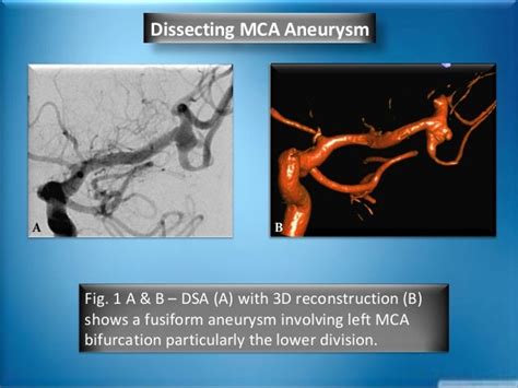 Dissecting MCA Aneurysm