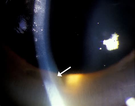 Kayser-Fleischer Ring: A Systems Based Review of the Ophthalmologist's Role in the Diagnosis of ...