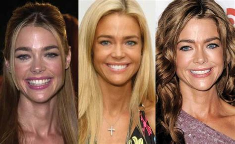 Denise Richards Plastic Surgery Before and After Pictures 2021