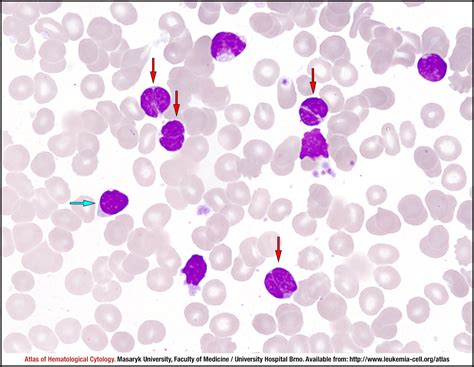 Follicular lymphoma - CELL - Atlas of Haematological Cytology