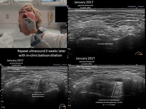 Parotid Gland Duct Ultrasound