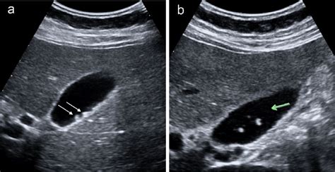 Gallbladder Ultrasound Sludge