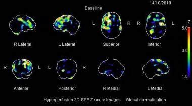 Spect Brain